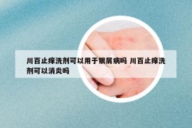 川百止痒洗剂可以用于银屑病吗 川百止痒洗剂可以消炎吗