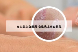 女人头上白癜风 女生头上有白头发