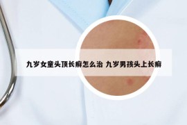 九岁女童头顶长癣怎么治 九岁男孩头上长癣