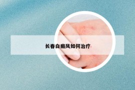 长春白癜风如何治疗