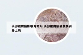 头部银屑病影响寿命吗 头部银屑病会发展到身上吗