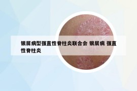 银屑病型强直性脊柱炎联合会 银屑病 强直性脊柱炎