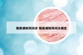 银屑病如何问诊 银屑病如何问诊病史