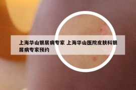 上海华山银屑病专家 上海华山医院皮肤科银屑病专家预约