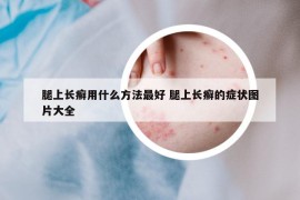 腿上长癣用什么方法最好 腿上长癣的症状图片大全