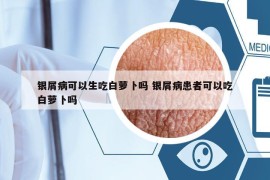 银屑病可以生吃白萝卜吗 银屑病患者可以吃白萝卜吗