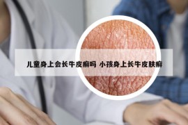 儿童身上会长牛皮癣吗 小孩身上长牛皮肤癣