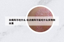 白癜风不吃什么 白点癫风不能吃什么食物和水果