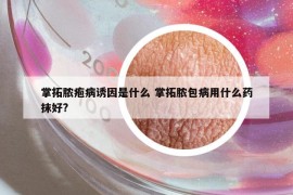 掌拓脓疱病诱因是什么 掌拓脓包病用什么药抹好?