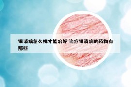 银消病怎么样才能冶好 治疗银消病的药物有那些