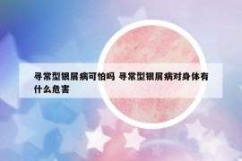 寻常型银屑病可怕吗 寻常型银屑病对身体有什么危害