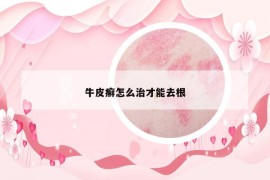 牛皮癣怎么治才能去根