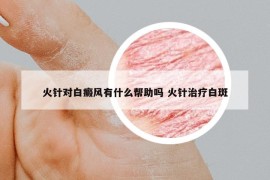 火针对白癜风有什么帮助吗 火针治疗白斑