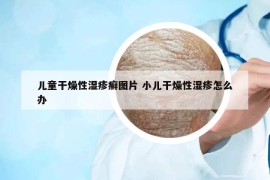 儿童干燥性湿疹癣图片 小儿干燥性湿疹怎么办