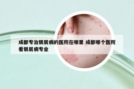 成都专治银屑病的医院在哪里 成都哪个医院看银屑病专业