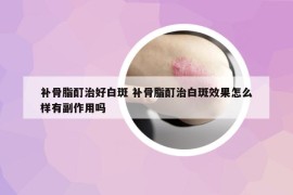 补骨脂酊治好白斑 补骨脂酊治白斑效果怎么样有副作用吗