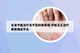 名老中医治疗关节型的银屑病 中医怎么治疗银屑病关节炎