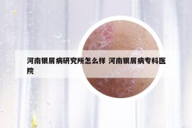 河南银屑病研究所怎么样 河南银屑病专科医院