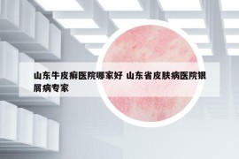 山东牛皮癣医院哪家好 山东省皮肤病医院银屑病专家