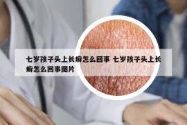 七岁孩子头上长癣怎么回事 七岁孩子头上长癣怎么回事图片