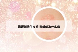 海螵蛸治牛皮癣 海螵蛸冶什么病