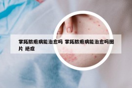 掌跖脓疱病能治愈吗 掌跖脓疱病能治愈吗图片 绝症