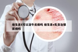 维生素E可以涂牛皮癣吗 维生素e乳膏治银屑病吗