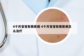 4个月宝宝有银屑病 4个月宝宝有银屑病怎么治疗