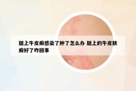 腿上牛皮癣感染了肿了怎么办 腿上的牛皮肤癣好了咋回事