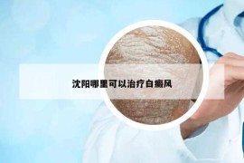 沈阳哪里可以治疗白癜风