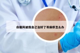 白癜风被我自己治好了荨麻疹怎么办