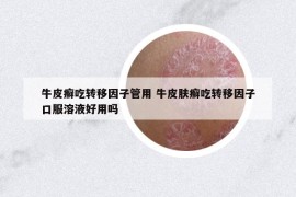 牛皮癣吃转移因子管用 牛皮肤癣吃转移因子口服溶液好用吗