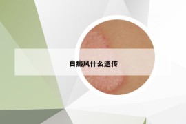 白癜风什么遗传