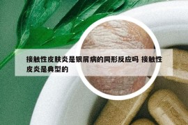 接触性皮肤炎是银屑病的同形反应吗 接触性皮炎是典型的