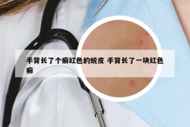 手背长了个癣红色的蜕皮 手背长了一块红色癣