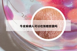 牛皮癣病人可以吃衡糖胶囊吗