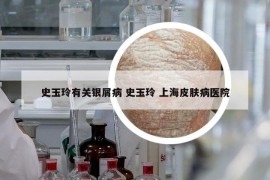 史玉玲有关银屑病 史玉玲 上海皮肤病医院