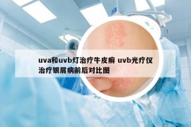 uva和uvb灯治疗牛皮癣 uvb光疗仪治疗银屑病前后对比图