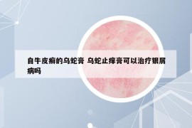 自牛皮癣的乌蛇膏 乌蛇止痒膏可以治疗银屑病吗