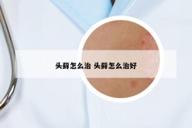 头藓怎么治 头藓怎么治好