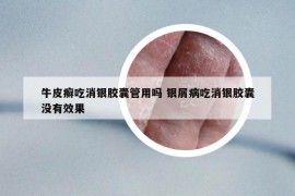 牛皮癣吃消银胶囊管用吗 银屑病吃消银胶囊没有效果