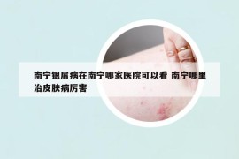 南宁银屑病在南宁哪家医院可以看 南宁哪里治皮肤病厉害