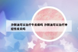 沙棘油可以治疗牛皮癣吗 沙棘油可以治疗神经性皮炎吗