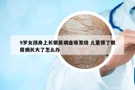 9岁女孩身上长银屑病连带发烧 儿童得了银屑病长大了怎么办