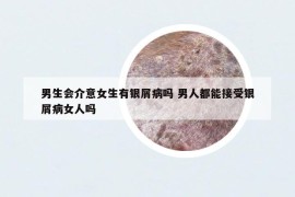 男生会介意女生有银屑病吗 男人都能接受银屑病女人吗