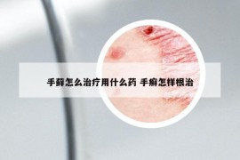 手藓怎么治疗用什么药 手癣怎样根治