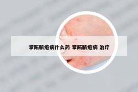 掌跖脓疱病什么药 掌跖脓疱病 治疗