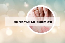 白斑的图片长什么样 白斑图片 区别