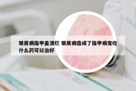 银屑病指甲盖溃烂 银屑病造成了指甲病变吃什么药可以治好