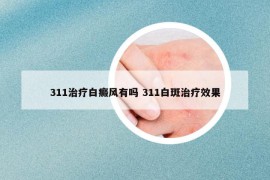 311治疗白癜风有吗 311白斑治疗效果